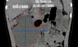 Cháu bé 26 tháng tuổi mắc khối u nang lớn, hiếm gặp, chèn ép gần một nửa vùng bụng phải