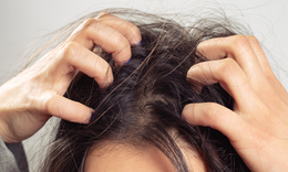 Da đầu g&#224;u – ngứa k&#233;o d&#224;i: 6 nguy&#234;n nh&#226;n &#237;t ai ngờ tới khiến vấn đề trở nặng