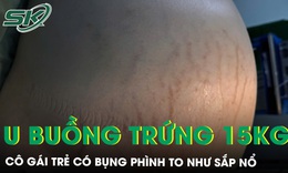 Bụng ph&#236;nh to như sắp nổ c&#244; g&#225;i trẻ mang u buồng trứng khổng lồ 15kg