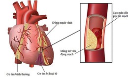 5 biện ph&#225;p giảm nguy cơ biến cố tim mạch khi thời tiết lạnh