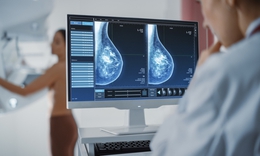 Ai nên chụp nhũ ảnh thường xuyên để phát hiện sớm ung thư vú?