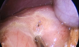 Phẫu thuật cấp cứu bệnh nhi 13 tuổi bị thủng ổ lo&#233;t dạ d&#224;y – t&#225; tr&#224;ng v&#224; lời cảnh tỉnh từ b&#225;c sĩ