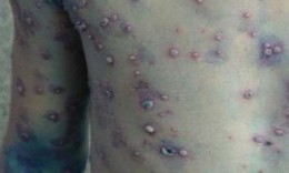 Bệnh thuỷ đậu dễ gặp mùa xuân, cách nhận biết và phòng tránh 