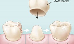 Cách nào hạn chế răng sứ xỉn màu?