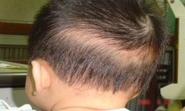 Trẻ bị rụng tóc hình vành khăn có đáng lo ngại?