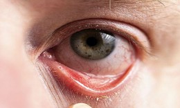 6 biện pháp phòng ngừa dị ứng mắt