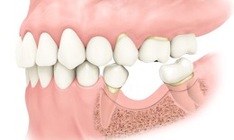 Ai cần ghép xương trong cấy ghép implant?