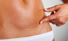 Chửa ở vết mổ: Nguyên nhân, biểu hiện, cách điều trị và phòng bệnh