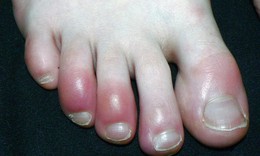 Xử trí sưng đỏ do cước tay chân