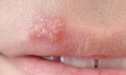 Thuốc trị mụn rộp do nhiễm herpes m&#244;i