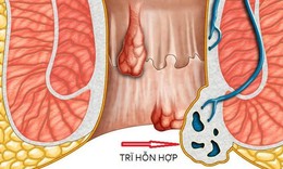 Khi n&#224;o người bệnh trĩ cần đến bệnh viện?