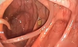 C&#225;c th&#243;i quen khiến bạn dễ mắc giun đũa v&#224; c&#225;ch ph&#242;ng ngừa
