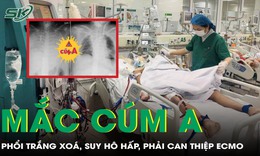 Mắc c&#250;m A suốt 3 tuần, người đ&#224;n &#244;ng nguy kịch, phổi trắng x&#243;a, phải can thiệp ECMO khẩn cấp
