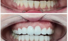 Những lưu ý khi bọc răng sứ