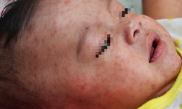 Sốt phát ban dạng sởi có thể gây tử vong, những dấu hiệu nguy kịch cần biết
