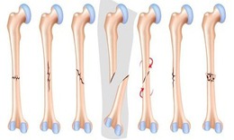 G&#227;y xương: Nguy&#234;n nh&#226;n, triệu chứng, c&#225;ch ph&#242;ng tr&#225;nh v&#224; điều trị