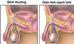 Giãn tĩnh mạch thừng tinh: Nguyên nhân, biểu hiện, cách điều trị và phòng bệnh