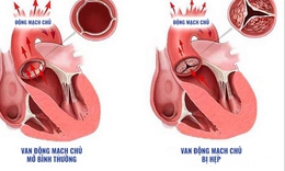 Hẹp van động mạch chủ: Nguy&#234;n nh&#226;n, triệu chứng, c&#225;ch điều trị v&#224; dự ph&#242;ng