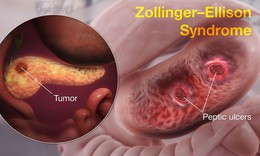 Hội chứng Zollinger - Ellison: Nguyên nhân, biểu hiện, cách điều trị và phòng bệnh