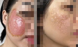 Hoảng hồn với làn da bị bào mòn, chảy dịch vì laser chữa nám má ở spa