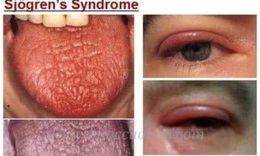 Hội chứng Sjogren: Nguyên nhân, biểu hiện, cách điều trị và phòng bệnh