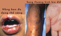 Hồng ban đa dạng: Nguyên nhân, biểu hiện, cách điều trị và phòng bệnh