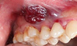 8 dấu hiệu cảnh báo ung thư khoang miệng