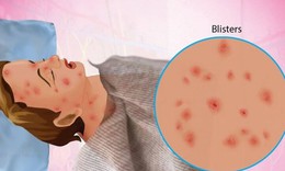 Hội chứng Stevens - Johnson: Nguyên nhân, biểu hiện, cách điều trị và phòng bệnh