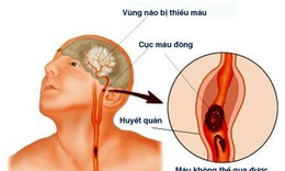 Dấu hiệu nhận biết nhanh người bị đột quỵ cần gọi ngay cấp cứu