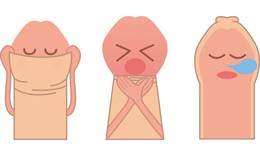 Hẹp bao quy đầu: Nguy&#234;n nh&#226;n, biểu hiện, c&#225;ch điều trị v&#224; ph&#242;ng bệnh