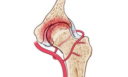 Hoại tử chỏm xương đùi: Nguyên nhân, biểu hiện, cách điều trị và phòng bệnh