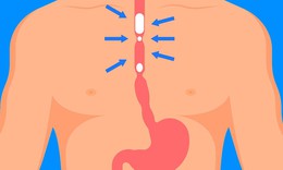 Hẹp thực quản: Nguyên nhân, biểu hiện, cách điều trị và phòng bệnh