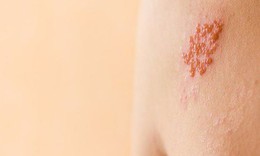 Thuốc điều trị đau và sẹo do zona thần kinh