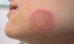 Dùng thuốc trị hắc lào cần lưu ý gì?