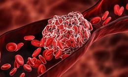 Thuốc điều trị hội chứng kháng thể kháng phospholipid