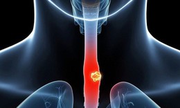 Loét thực quản: Nguyên nhân, biểu hiện, cách điều trị và phòng bệnh
