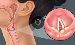 Chế độ ăn cho bệnh nhân liệt cơ mở thanh quản