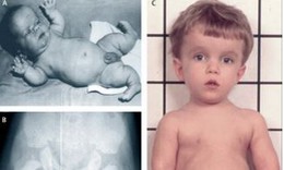 Loạn sản sụn xương: Nguyên nhân, biểu hiện, cách điều trị và phòng bệnh
