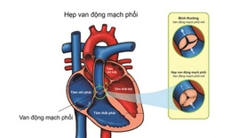 Câu hỏi thường gặp liên quan đến bệnh hẹp động mạch phổi