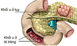 Câu hỏi thường gặp liên quan đến hội chứng Zollinger-Ellison