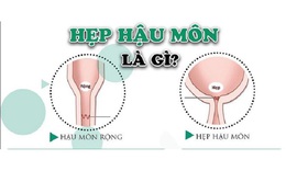 Câu hỏi thường gặp liên quan đến hẹp hậu môn ở trẻ em