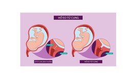 Câu hỏi thường gặp liên quan đến bệnh hở eo tử cung