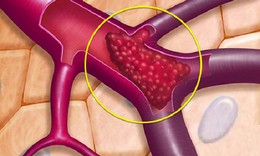 Câu hỏi thường gặp trong bệnh huyết khối