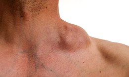 C&#226;u hỏi thường gặp li&#234;n quan đến bệnh Hodgkin