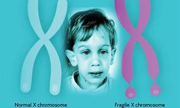 6 điều cần biết về hội chứng Fragile X