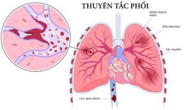 Thuyên tắc phổi: Nguyên nhân, triệu chứng, cách điều trị và phòng bệnh