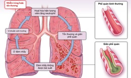 Giãn phế quản: Nguyên nhân, biểu hiện, cách điều trị và phòng bệnh