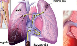 Thuốc và các phương pháp điều trị thuyên tắc phổi