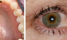 Câu hỏi thường gặp liên quan đến hội chứng Sjogren