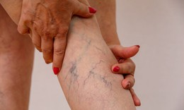 Các thuốc điều trị giãn tĩnh mạch chân